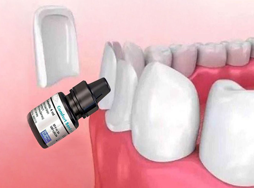 انواع-چسب-دندانپزشکی-و-کاربردهای-آن