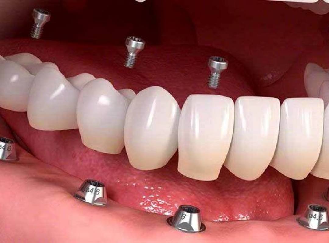 مزایا-و-معایب-استفاده-از-ایمپلنت-کره-ای