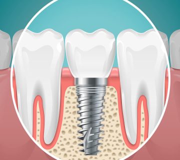 حداقل-سن-برای-کاشت-ایمپلنت-دندان-چقدر-است؟