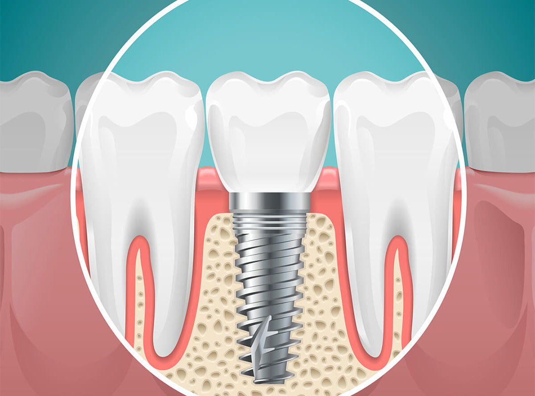 حداقل-سن-برای-کاشت-ایمپلنت-دندان-چقدر-است؟