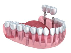 حداقل-سن-برای-کاشت-ایمپلنت-دندان-چقدر-است؟